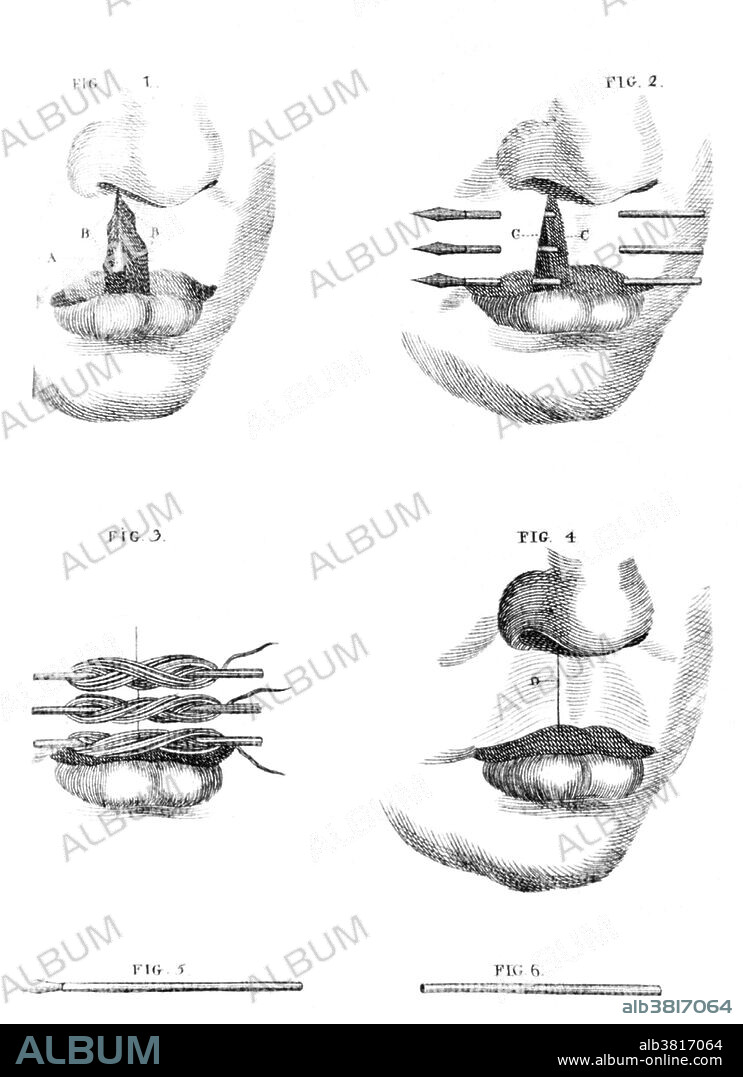 1791 Engraving entitled: Procedure for treating cleft lip. Partial view of a face showing the steps for treating a cleft lip. Plate LVII from Benjamin Bell's "A System of Surgery". The history of surgery of cleft lip and palates reaches as far backwards as the pre-christian era to 390 B.C. when for the first time a cleft lip was closed successfully in China. In the middle ages operations on cleft lip have been several times described. A successful operation on a cleft palate did however not occur until 1816. This can be explained by the fact that cleft palates were thought to be secondary to syphilis, but also because without anesthetic this operation was extremely painful and difficult.