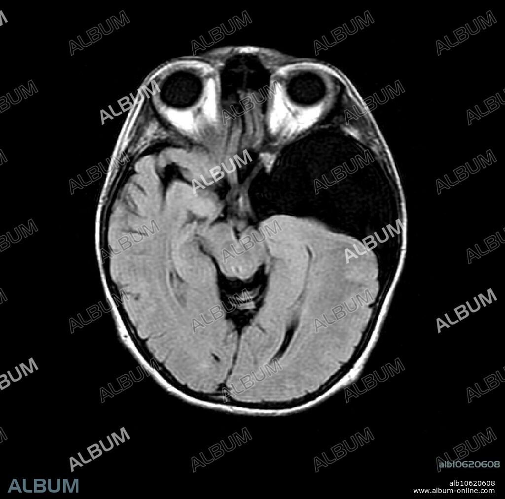 This axial (cross section) MRI image of the brain shows a large left middle cranial fossa arachnoid cyst (at right, dark). This is an abnormal collection of CSF (cerebral spinal fluid) which is walled off and acts like a mass. It is benign but can cause a variety of symptoms including seizures.