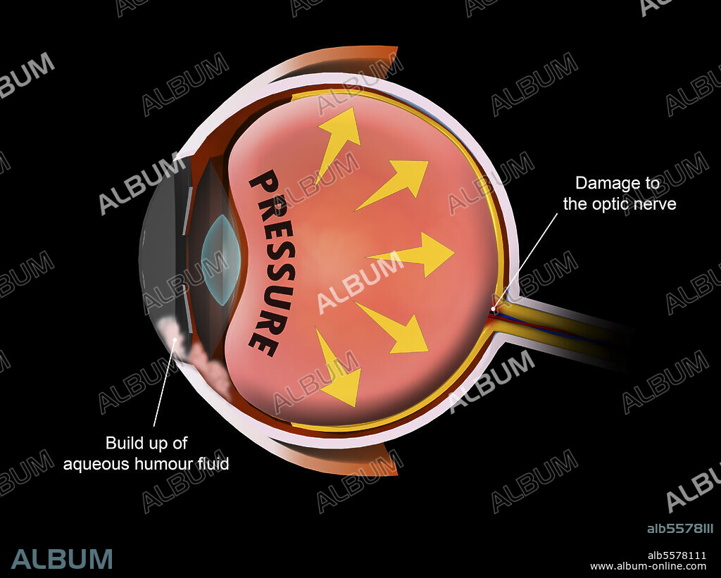 Medical illustration showing increased pressure in the eyeball, leading to glaucoma.