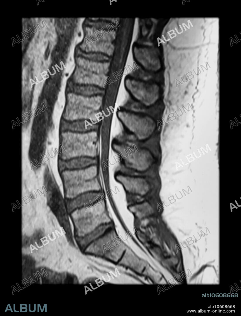 This sagittal T1 weighted MR of the lumbar spine shows extensive epidural lipomatosis with associated marked compression/deformity of the thecal sac. This person is also morbidly obese.