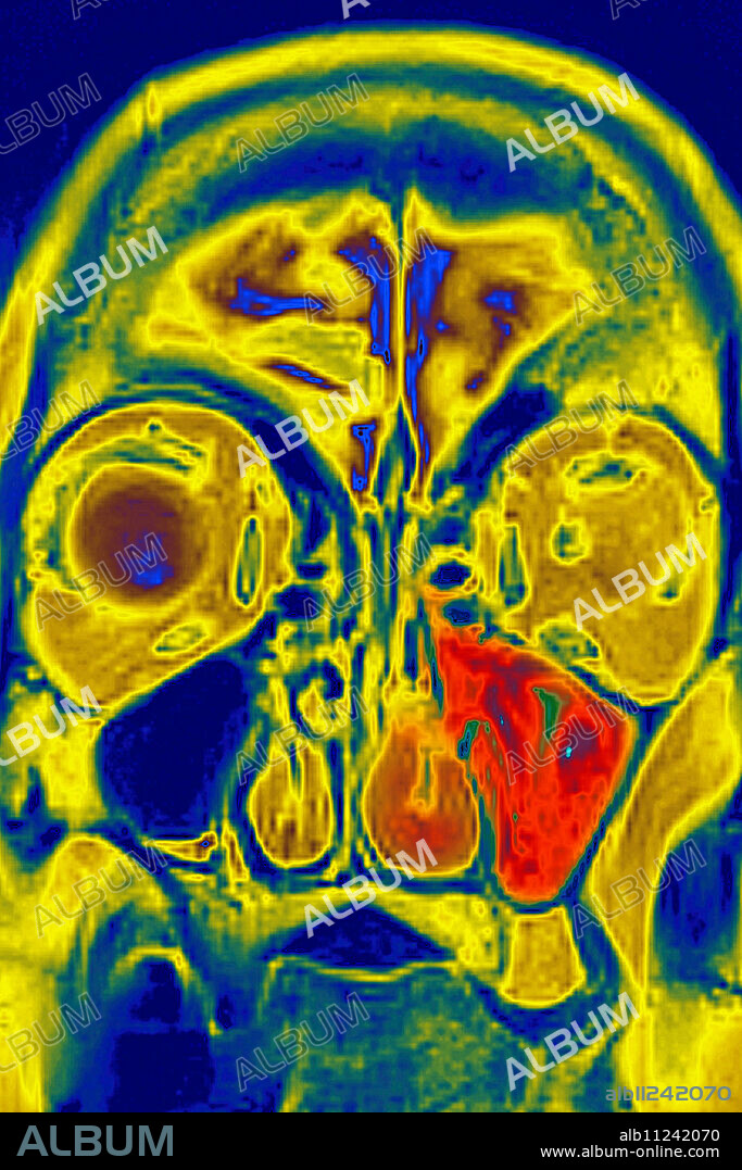 Sinusitis in the left maxillary sinus, seen on a frontal, cross-section MRI scan.