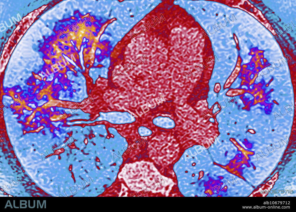 Pulmonary vasculitis (a disease involving inflammation of the walls of blood vessels). Thoracic CT (computed tomography) scan in radial section.