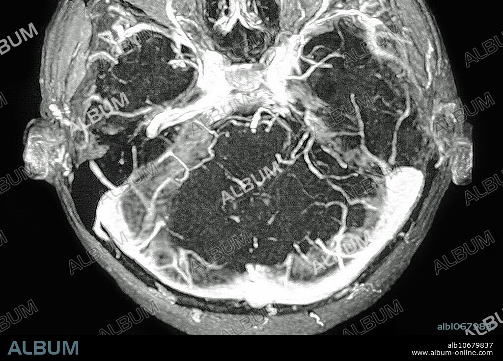 Thrombosis of venous sinuses of the dura mater, visualized by a cranial MRI angiography.