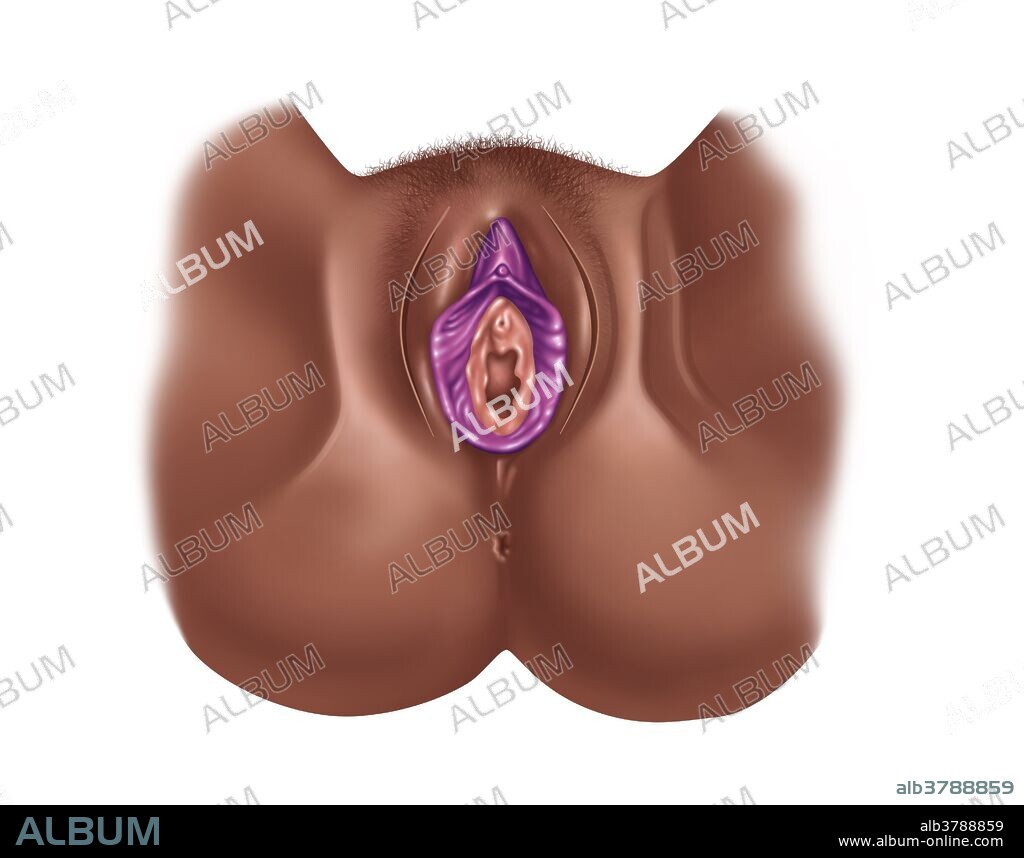 Total Excision of Clitoris & Labia - Album alb3788859