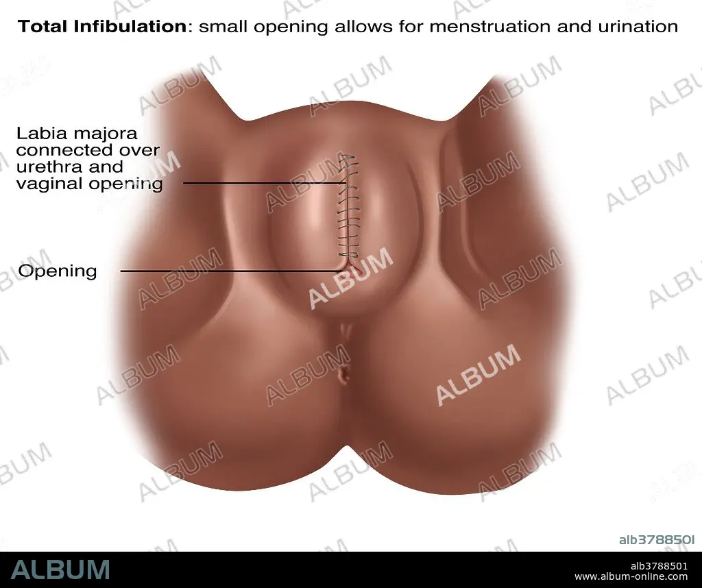 Total Infibulation, Illustration - Album alb3788501