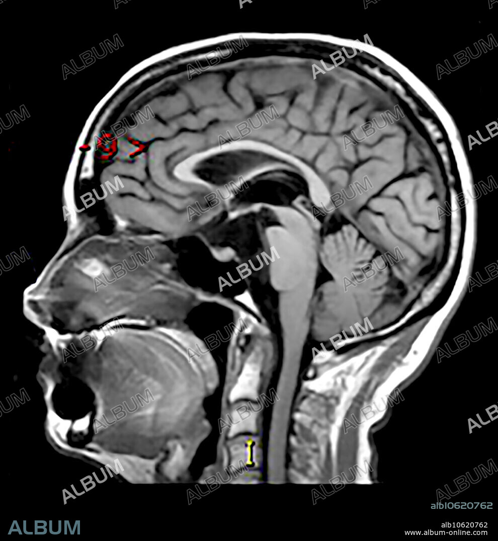 This sagittal (from the side) T1 weighted MR image without contrast shows a hypointense mass like region in the prepontine cistern with compression of the brainstem. This represents an epidermoid tumour/cyst which is a congenital lesion consisting of keratinized epithelium with desquamation. These expand/grow over time. This is the same as a congenital cholesteatoma.