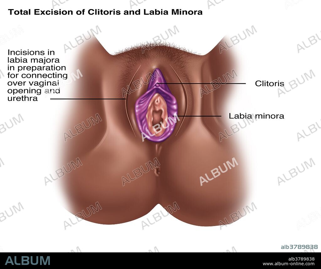 Total Excision of Clitoris & Labia - Album alb3789838