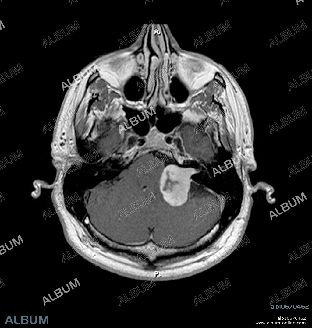 This axial (cross sectional) MRI image of the brain at the level of the internal auditory canals shows a large enhancing tumour- in the left CP angle cistern and left internal auditory canal consistent with a large acoustic schwannoma. This caused unilateral hearing loss. MRI is the preferred method to evaluate patients with hearing loss.