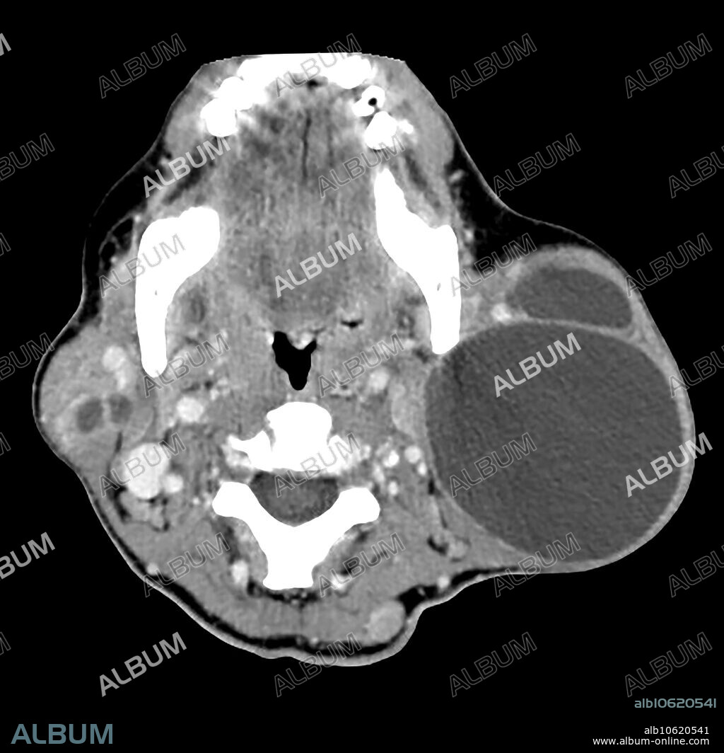 This axial (cross sectional) contrast enhanced CT of the upper neck shows benign lymphoepithelial cysts in the parotid glands. These are commonly seen in the setting of HIV/AIDS disease. They can be cystic or solid.