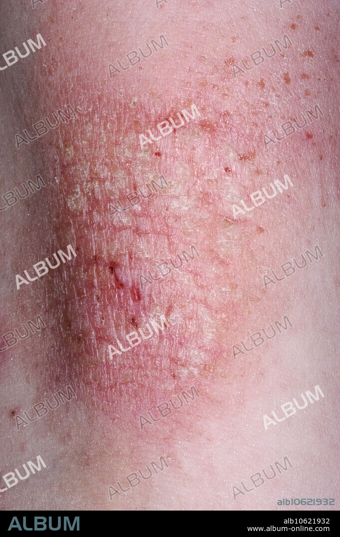 Eczema skin rash on the knee. Eczema or dermatitis is a chronic skin disorder that shows up as scaly and itchy rashes. Other symptoms include blisters, dry/leathery skin, and ear discharge or bleeding. Eczema is due to a hypersensitivity in the skin, not unlike an allergy, which can lead to long-term inflammation. Eczema is most common in infants and tends to run in families. In contrast to psoriasis, eczema is often likely to be found on the flexor aspect of joints.