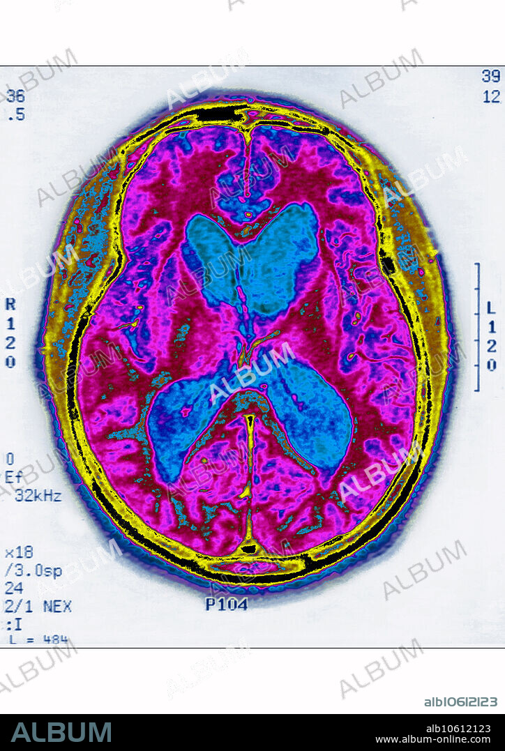 Brain MRI in a radial section showing Alzheimer's disease, cerebral atrophy, which is the cause of a progressive dementia.