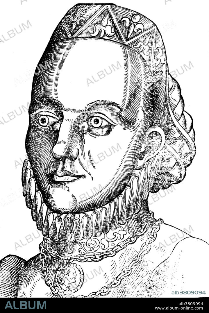 Woodcut of a woman showing abnormal tear flow. Lacrimal fistula is an abnormal opening into a tear duct or the lacrimal sac. Appeared in Ophthalmodouleia by Georg Bartisch (1535-1607) a German physician. He began his medical career, at the age of 13, as an apprentice to a barber surgeon. He was considered a skilled practitioner of ocular medicine and surgery. His Renaissance manuscript on ophthalmic disorders and eye surgery, Ophthalmodouleia Das ist Augendienst (1583), discussed ocular diseases, surgical techniques, instruments, including woodcuts depicting diseases of the eye. Despite his skill as a surgeon, he was a superstitious individual, as he believed that magic, astrology and witchcraft played a significant part in medicine.