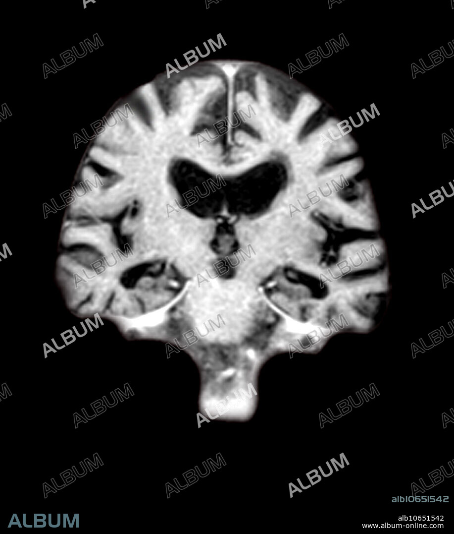 This coronal (frontal) MRI image of the brain shows severe generalized atrophy of brain tissue with an accentuated loss of tissue involving the temporal lobes in a person with advanced Alzheimers disease.