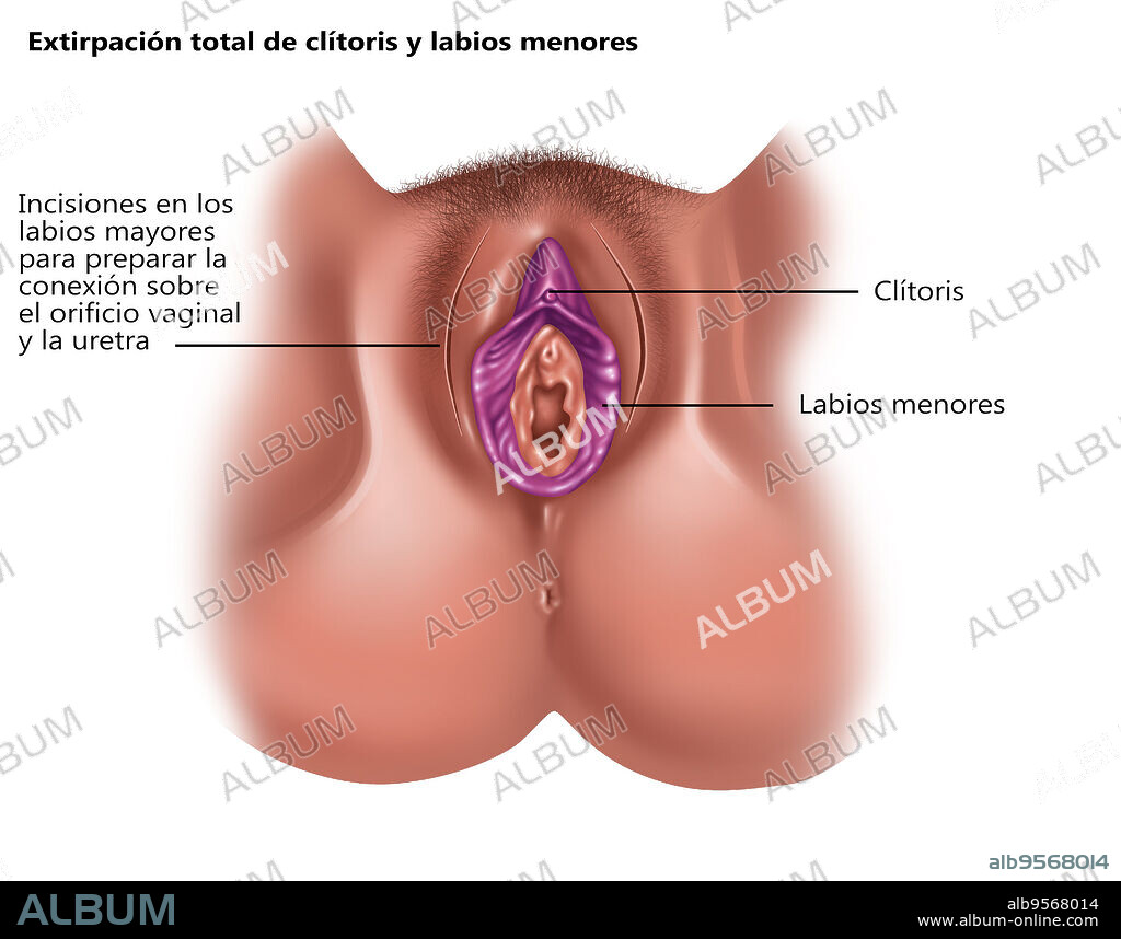 Total Excision of Clitoris & Labia - Album alb9568014