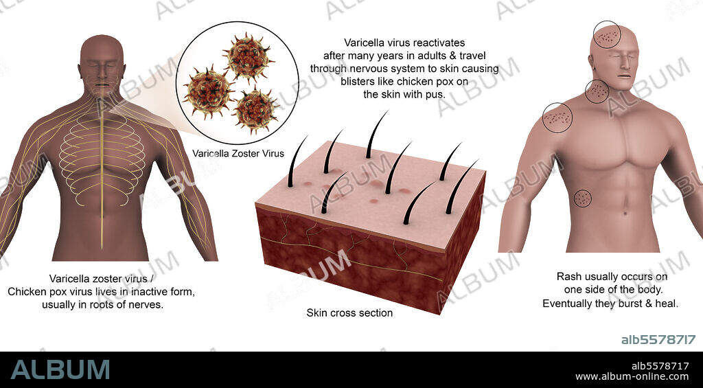 Medical diagram showing shingles caused by the varicella-zoster virus.