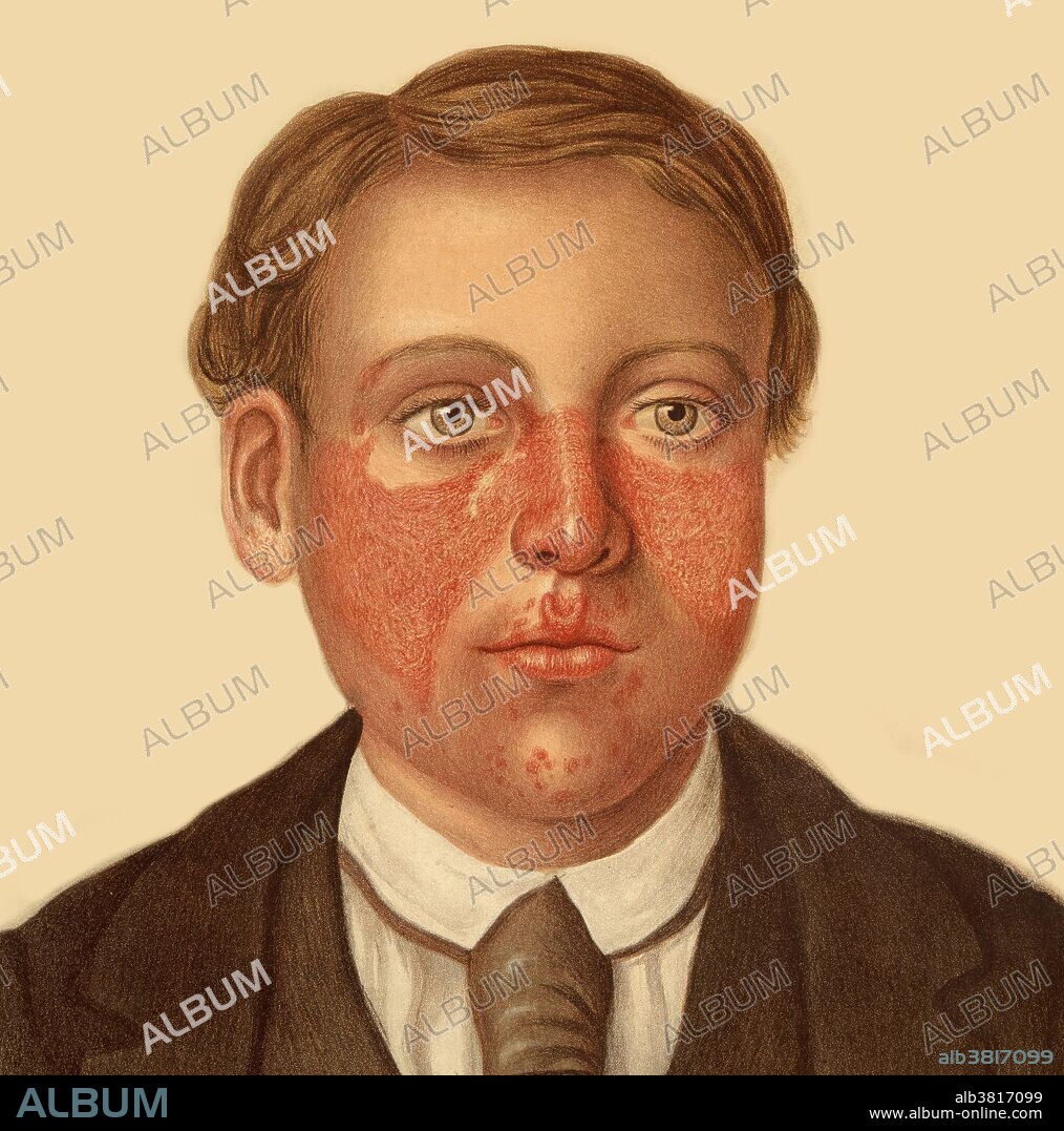 This image shows a young male with Lupus Erythematosus. This auto-immune disease is classified into two types: Systemic Lupus Erythematosus (SLE) which involves multiple parts of the body and Discoid Lupus Erythematosus (DLE) where only the skin is affected. The young man in the image shows classic symptoms of the disease such as the butterfly rash (so called as its appearance is like that of a butterfly with outstretched wings) across his cheeks and circular (discoid) lesions on his hands. Chromolithograph, 1878-1888. Illustration by E. Burgess after R. W. Sherwin, Mabel Green and Jonathan Hutchinson.