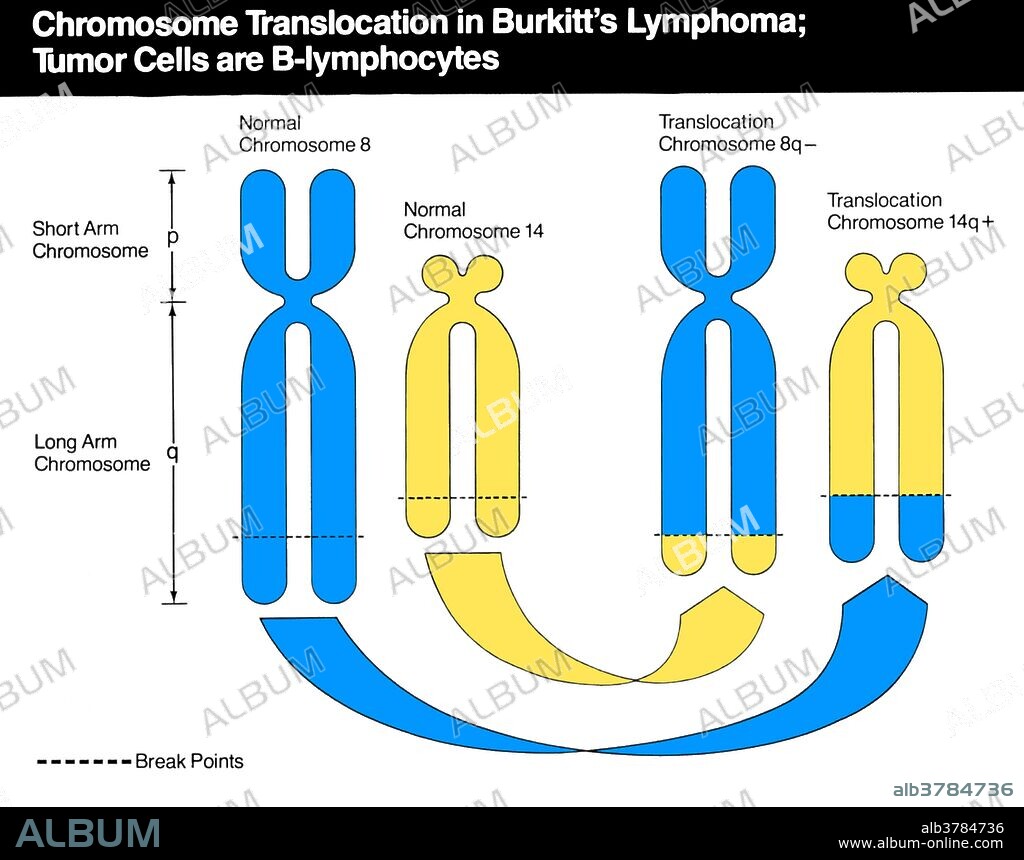 Schematic diagram of chromosomes 8, 2, 14, and 22 which are involved in the translocations (usually 8;14, less frequently 8;22 or 2;8) which occur in Burkitt's Lymphoma. The break points for these translocations are identified by the banding regions (q24, p13, q32 and q11). These break points on chromosomes 2, 14, and 22 correspond to chromosomal regions to which have been mapped the kappa, heavy chain and lambda constant region genes respectively. Burkitt lymphoma is a cancer of the lymphatic system, particularly B lymphocytes found in the germinal center.