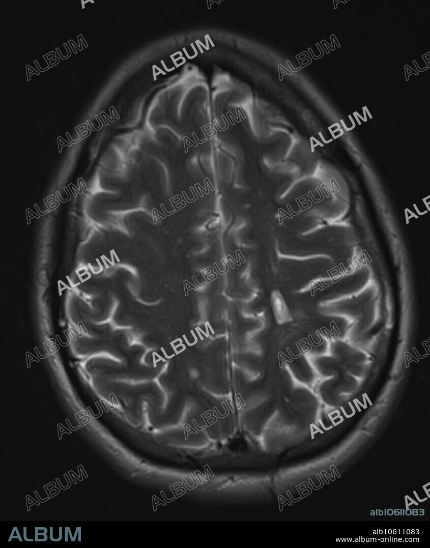 3.0T transverse, axial T2 MRI of 30 year old female with multiple sclerosis. Images reveal multiple foci of demyelinating disease throughout the periventricular and deep white matter. A chronic plaque results in a hole in the left parietal white matter centrum semiovale corona radiata.