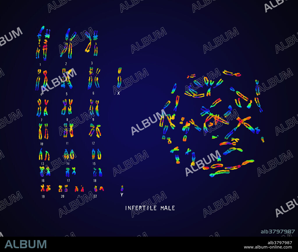 Colour enhanced micrograph of a karyotype of an infertile male. There are 22 pairs of chromosomes and also the gender determining pair (lower right corner). In men, this comprises one X and one Y chromosome. In women, it is made up of two X chromosomes. The Y chromosome carries genetic information responsible for the development of male characteristics. Chromosomes carry genetic information in the form of genes, lengths of DNA that act as recipes for proteins. Karyotypes are an arrangement of chromosomes based on their appearance under a light microscope.