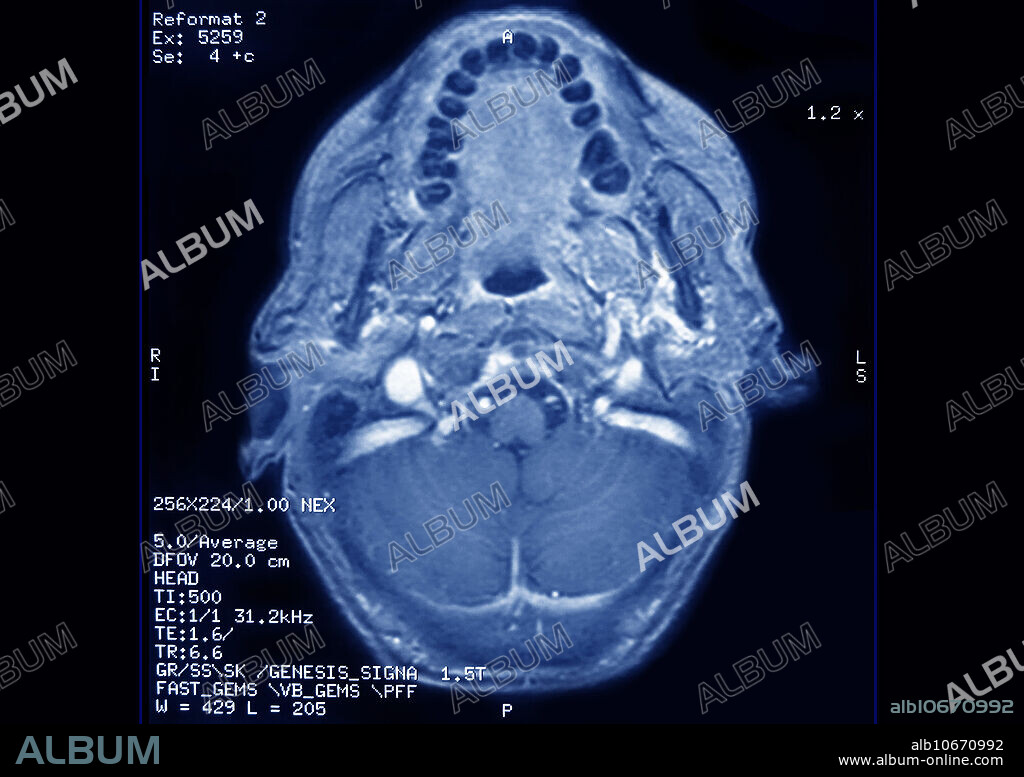 Brain MRI in radial section of the skull, cerebellum, cerebellar peduncle, pharynx, lower maxillary are visible. (Normal view).