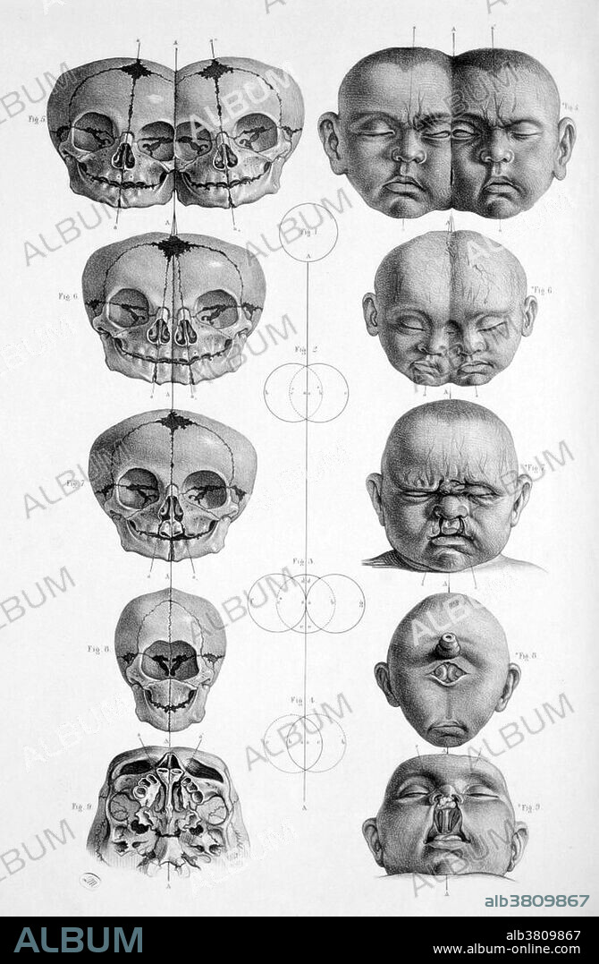 Head and skull of malformed infants; conjoined twins, bilateral cleft lip and holoprosencephaly, from Joseph Maclise's book Surgical Anatomy, published in London in 1856.