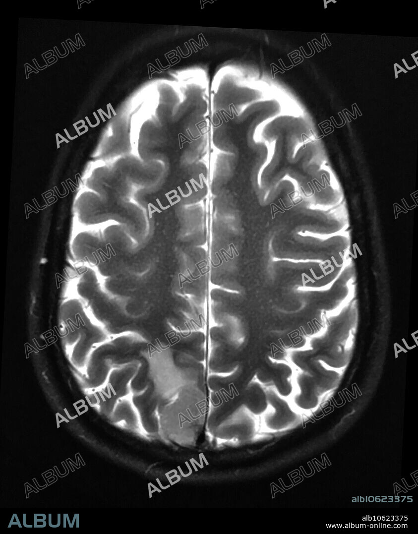 This axial (cross sectional) T2 weighted MR image shows a meningioma in the posterior-mesial aspect of the parietal lobe (also called the precuneus). Meningiomas are generally benign, non-aggressive tumours but can sometimes become malignant/aggressive.