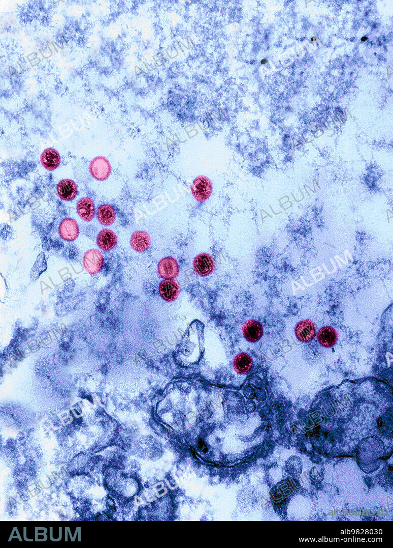 Transmission Electron Micrograph (TEM) revealing the presence of numerous Epstein-Barr virus (EBV) virions. The Epstein‚ÄìBarr virus (EBV), also called human herpesvirus 4 (HHV-4), is one of eight known human herpesvirus types in the herpes family, and is one of the most common viruses in humans.It is best known as the cause of infectious mononucleosis (glandular fever). It is also associated with particular forms of cancer, such as Hodgkin's lymphoma, Burkitt's lymphoma, gastric cancer, nasopharyngeal carcinoma, and conditions associated with human immunodeficiency virus (HIV), such as hairy leukoplakia and central nervous system lymphomas. Some 200,000 cancer cases per year are thought to be attributable to EBV. Infection with EBV occurs by the oral transfer of saliva and genital secretions. EBV is a double-stranded DNA (dsDNA) virus. Magnification: unknown.