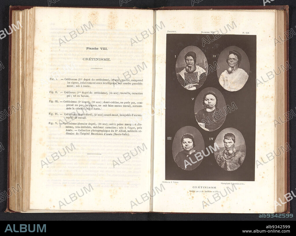 Five portraits of people suffering from cretinism, Crétinisme (title on object), J. Valette (mentioned on object), Lemercier & Cie. (mentioned on object), c. 1866 - in or before 1876, paper, height 166 mm × width 102 mm.