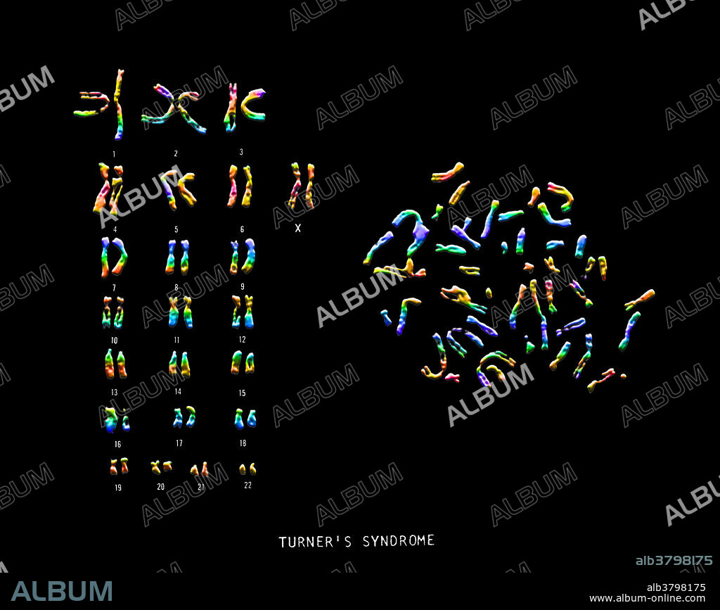 Colour enhanced micrograph of the karyotype of a patient with Turner's syndrome. A karyotype is an arrangement of the set of chromosomes. Turner's syndrome, which only affects women, is an absence of the second sex chromosome. In a healthy woman there would be two X chromosomes instead of one (seen at lower right). The symptoms of Turner's syndrome include stunted growth, retarded sexual development (leading to infertility), and webbing of the skin of the neck. Often heart problems are present too. Turner's syndrome is rare, affecting around one in every 3000 female births.