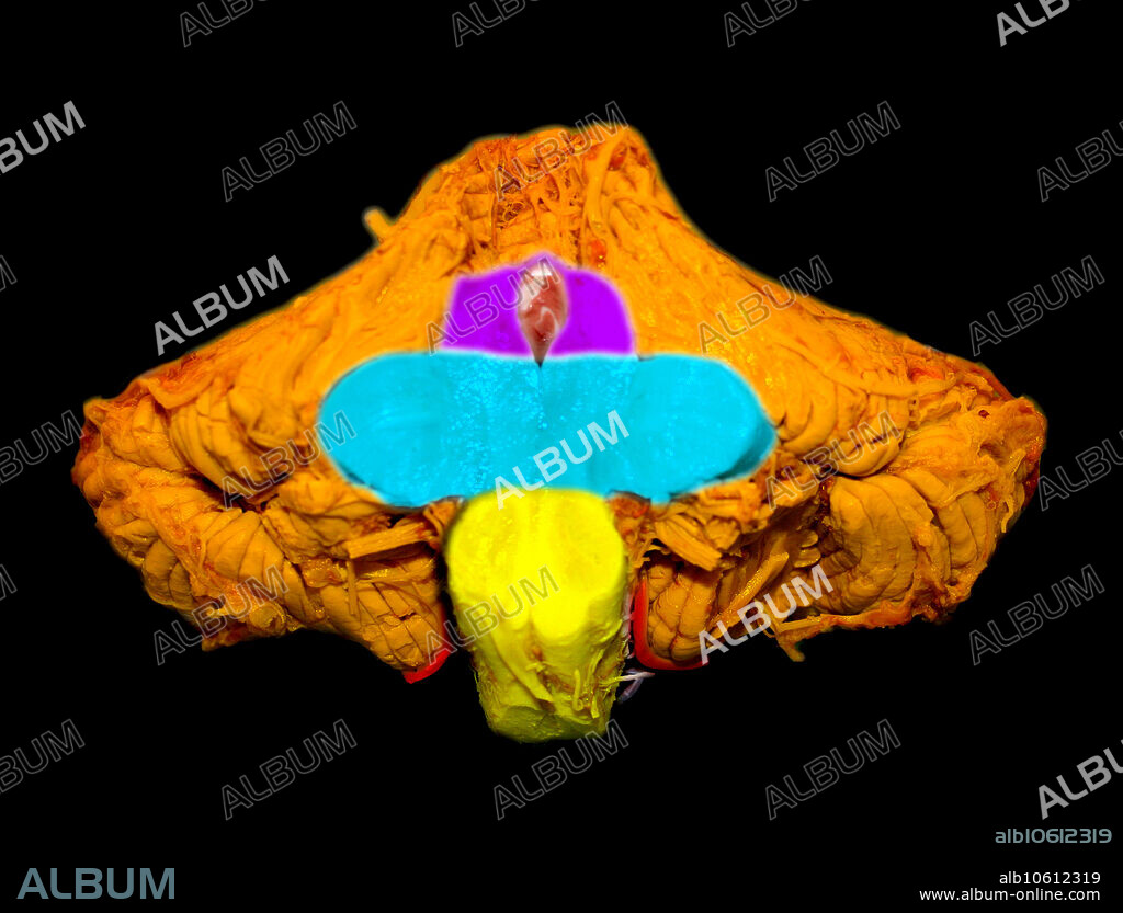 This colour enhanced cut section through the brainstem and cerebellum demonstrates normal anatomy of these regions. The cerebellum is orange. Visualized is the lower portion of the midbrain at the upper part of the cut brainstem (purple). The middle cerebellar peduncles and pons are seen in the mid portion of the cut brainstem (aqua). The cut section at the bottom of the image is the medulla (yellow). Also seen are some of the cranial nerves and vascular structures of the posterior fossa.