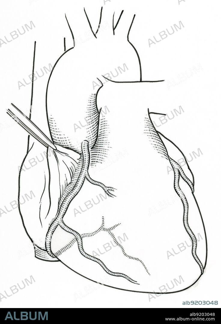 Anatomical illustration of the arteries of the heart, showing (on anterior) right coronary artery and acute marginal branch.