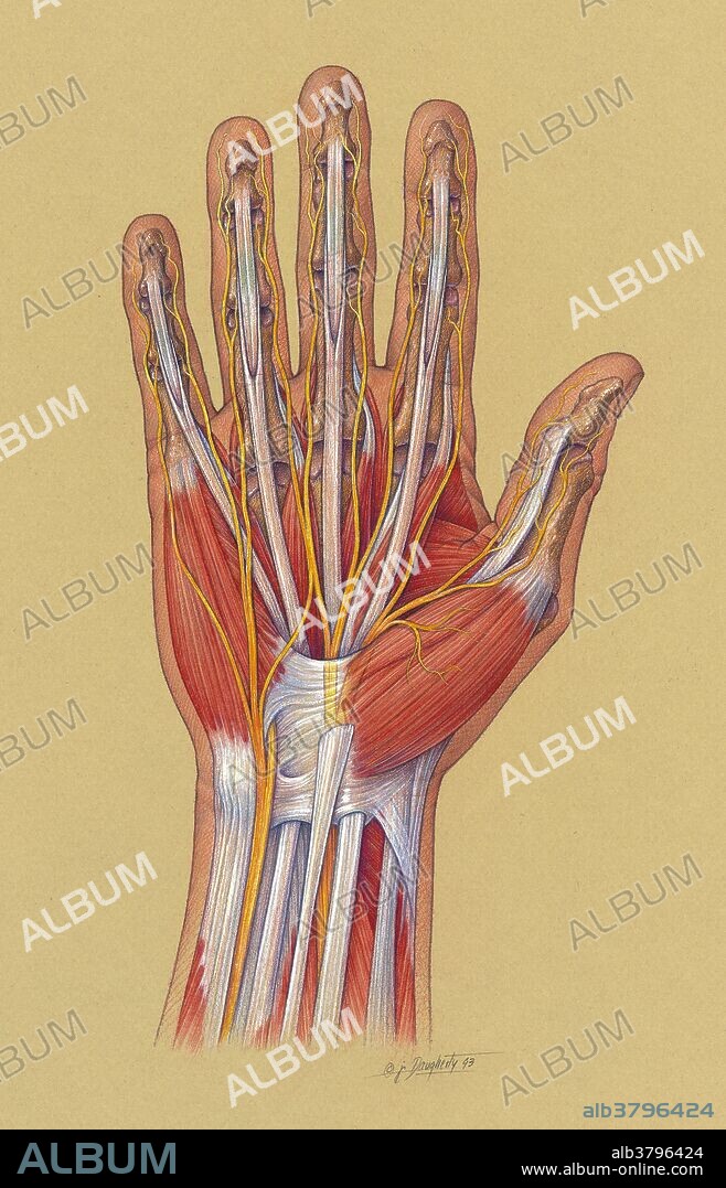 Carpal Tunnel Syndrome. Illustration of the anatomy of the hand and wrist showing the course of the median nerve. In carpal tunnel syndrome, the nerve is compressed in the carpal tunnel of the wrist. Carpal Tunnel Syndrome is caused by excessive use of the hand for specific tasks. Symptoms include pain, tingling, or numbness in the fingers or the entire hand, pain that shoots from the hands up the arm, and a swollen or tight feeling in the hands or wrists. Rest, using an ergonomically designed keyboard or glove, and actupunture may help to alleviate symptoms.