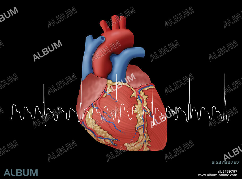 Illustration of a heart overlaid with an EKG showing an atrial flutter, an abnormal heart rhythm that occurs in the atria of the heart.