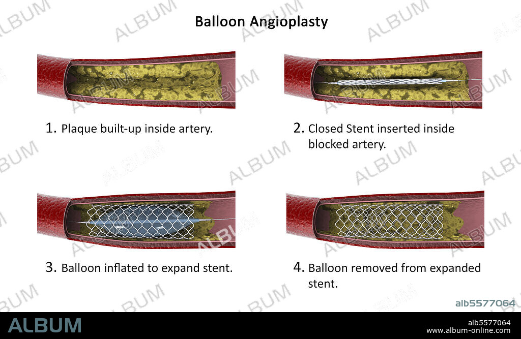 Diagram showing procedure of balloon angioplasty to widen obstructed arteries.