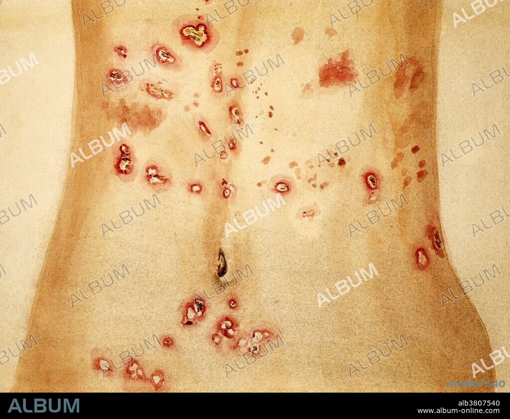 Watercolor drawing of the front of the abdomen of a woman aged 36, suffering from dermatitis herpetiformis. Drawing shows a number of small shallow ulcers covered by yellowish crusts, and scattered irregularly over the skin. They are rather more numerous on the right side than on the left, but occur on both sides of the middle line. Leonard Mark, 1892. Dermatitis herpetiformis, or Duhring's disease, is a chronic blistering skin condition characterised by blisters filled with a watery fluid. Despite its name, DH is neither related to nor caused by herpes virus: the name means that it is a skin inflammation having an appearance similar to herpes.