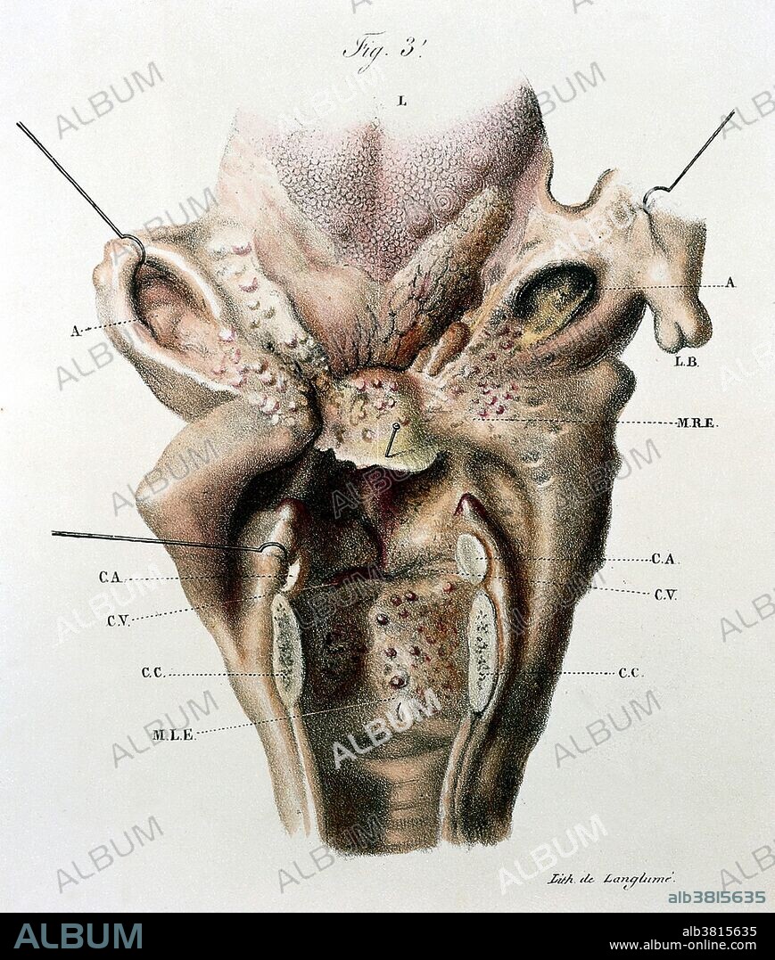 Illustration of diseased larynx. From "Anatomie pathologique du corps humain, 5th edition." J. Cruveilhier, published 1829-1842.