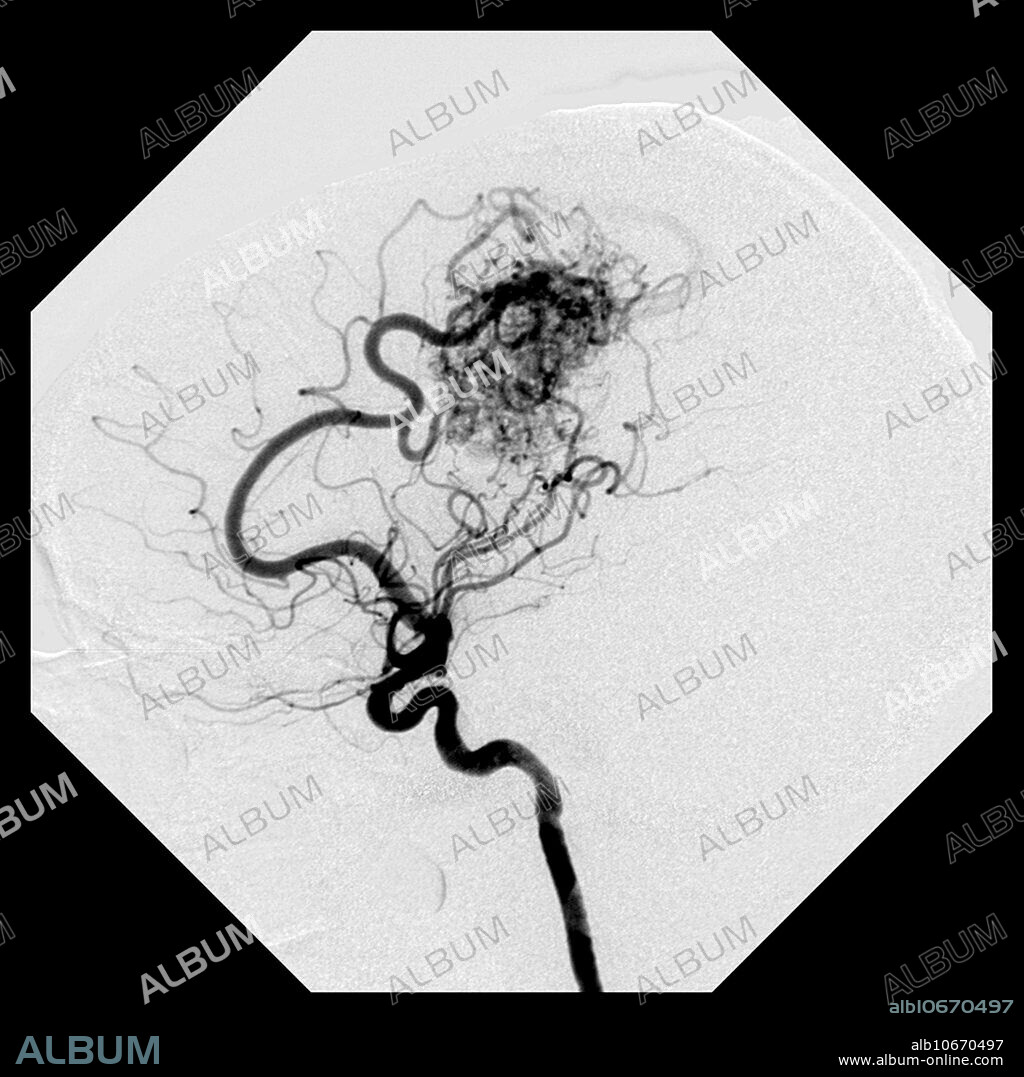 This lateral (from the side) image from an angiogram of the brains blood vessels shows the typical appearance of a high flow arterial venous malformation (AVM). There is enlargement of the pericallosal branch of the anterior cerebral artery supplying a large nidus (complex collection of abnormal blood vessels) and the very early appearance of the draining vein (along right side of the nidus). These are dangerous malformations of blood vessels that can lead to bleeding, stroke, seizures, headache and even death.