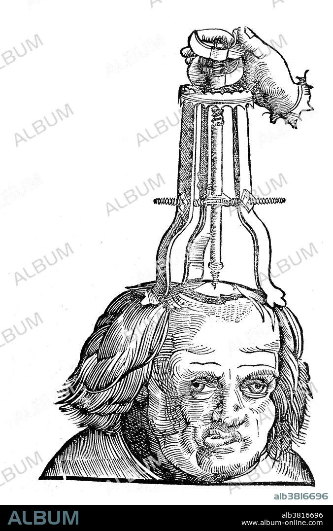 Removing the bone with a trochlea bipes, after trephination, 1527. Trepanning is a surgical intervention in which a hole is drilled or scraped into the human skull, exposing the dura mater to treat health problems related to intracranial diseases. Cave paintings indicate that people believed the practice would cure epileptic seizures, migraines, mental disorders and the bone that was trepanned was kept as a charm to keep evil spirits away. Trepanation was also practiced in the classical and Renaissance periods.