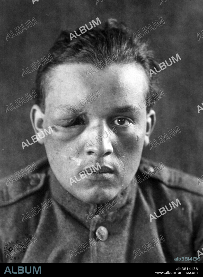 Wounded man at an unidentified base hospital in France during World War I. U.S. Signal Corps photo, circa 1914-1918. The total number of military and civilian casualties in World War I was over 37 million. There were over 16 million deaths and 21 million wounded ranking it among the deadliest conflicts in human history.